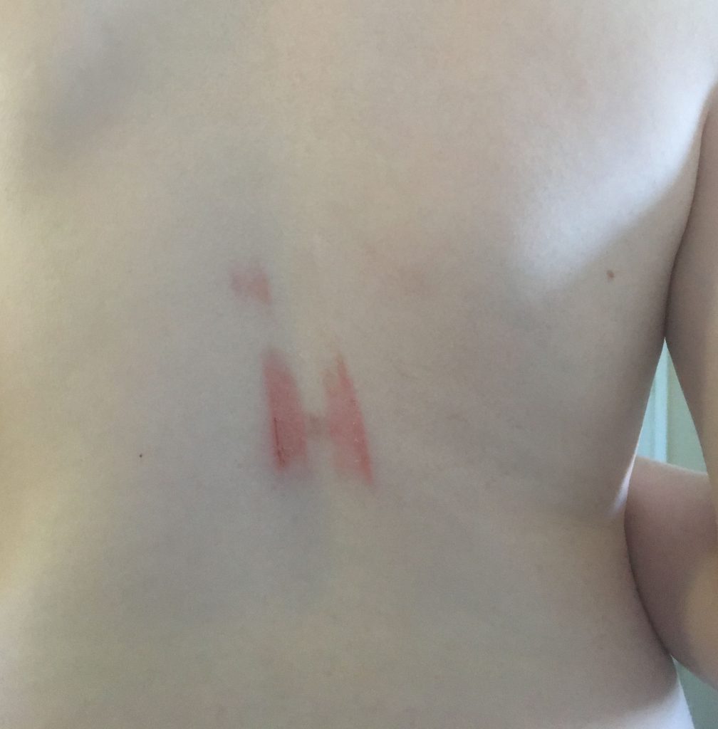 Back injury
